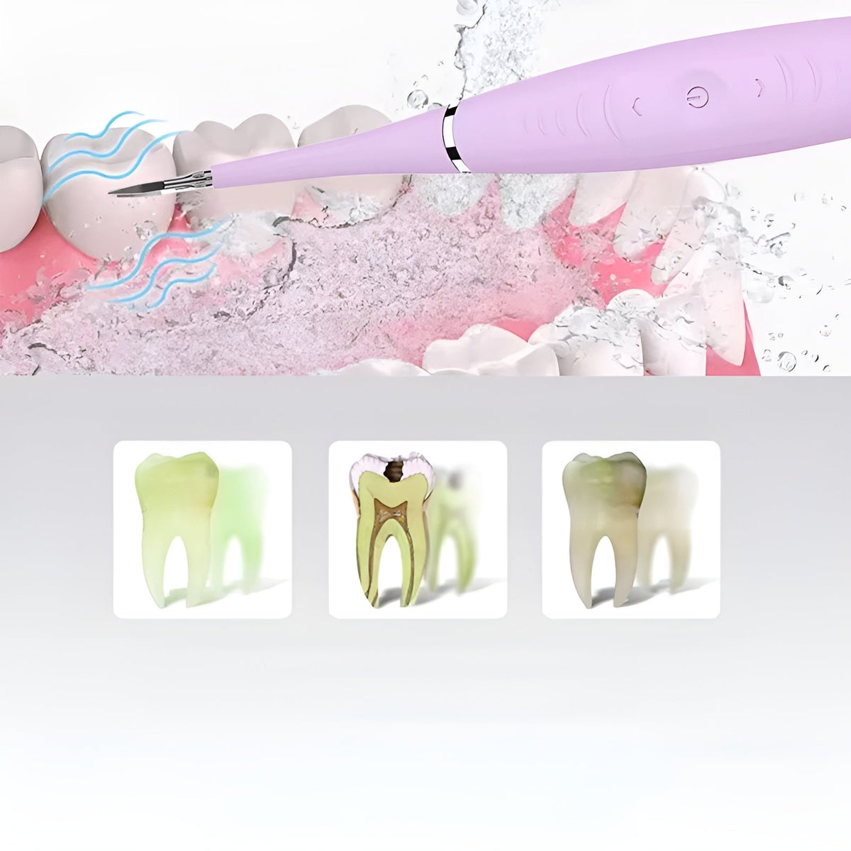Cleaner Pro° DentalCleaner: Professionell Tandsten Borttagare Tänder Rengöring Kit